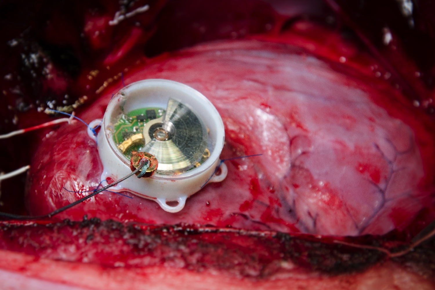 Clockwork Pacemaker Gives Your Heart a Swiss Watch Treatment