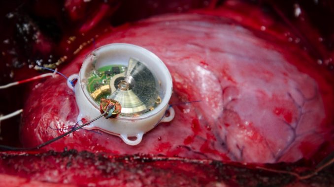 Clockwork Pacemaker Gives Your Heart a Swiss Watch Treatment